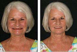 Dentures Before and After